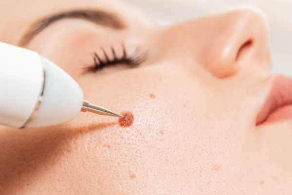 CryoPen: 5 Skin Concerns It May Be Used to Treat 3 What actually happens during a CryoPen treatment Great Missenden?