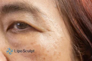 Cryopen: The Revolutionary Treatment for Age Spots Unveiled 2 Are age spots Great Missenden giving you low self esteem? Contact us today!