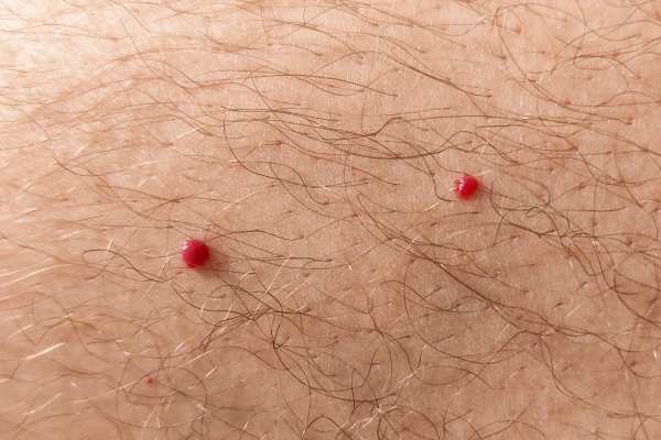 CryoPen: 5 Skin Concerns It May Be Used to Treat 2 cherry angioma removal Great Missenden