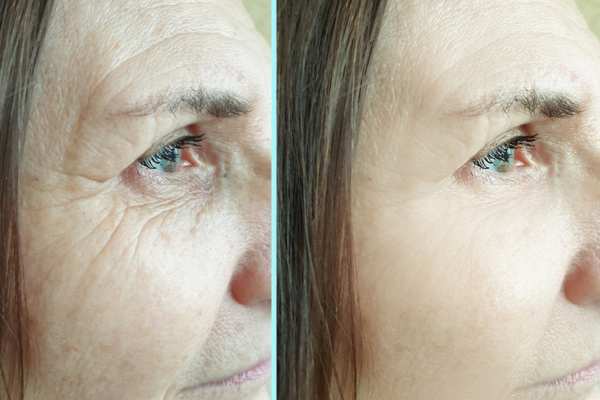 Why Do People Choose HIFU for a Non-Surgical Facelift? 4 How long can HIFU results last Great Missenden?