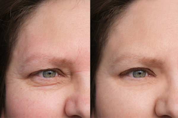 HIFU vs Botulinum Toxin: Understanding the Differences 4 How long do HIFU results last Great Missenden?