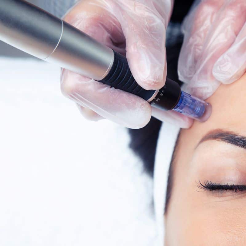 Morpheus8 treatment Great Missenden from Lipo Sculpt - Book in today!