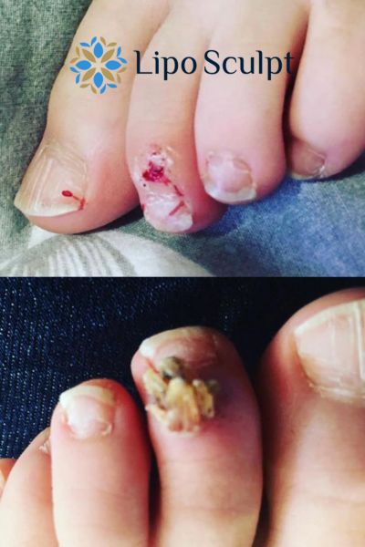 Wart removal customer results from Lipo Sculpt Great Missenden